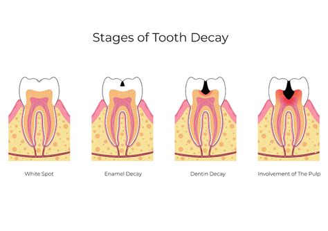 The Five Stages of a Cavity - Pediatric Dentistry - Pediatric Dental Center