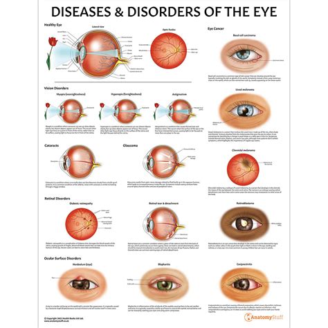 Eye Diseases Chart