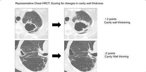 Stages of pulmonary lesions in MAC disease by chest CT score. Cavity ...