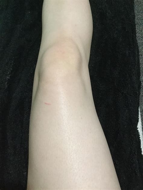 [misc] Stridex saved my legs from razor bumps and ingrown hairs! : r/SkincareAddiction