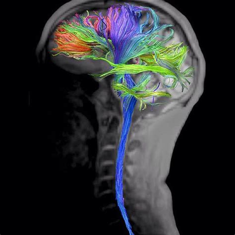 Brain and spine DTI Tractography based on RESOLVE sequence - MEDizzy