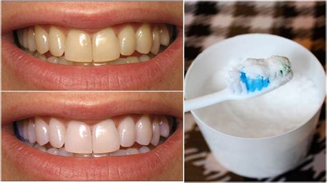 Pin on Teeth Whitening Before And After