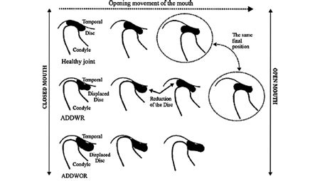 TMJ Internal Derangements - Oral Health Group