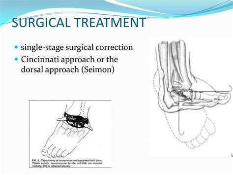 Congenital vertical talus UG lecture | PPT