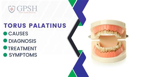 Torus Palatinus: Symptoms, Diagnosis, Causes, and Treatment - GPSH | Ganadhipati Purshottam ...