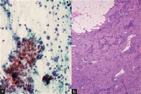 Endobronchial ultrasound-guided transbronchial needle aspiration biopsy is useful evaluating ...