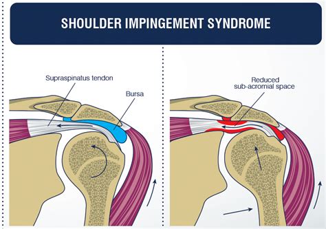 Shoulder Impingement | The Massage Clinic Health Centres