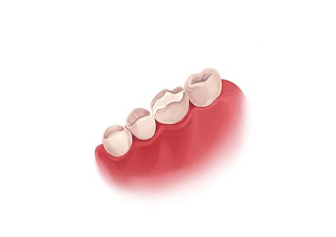 Cavity filling: types and procedure | Authority Dental