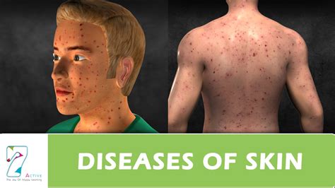 DISEASES OF SKIN - YouTube