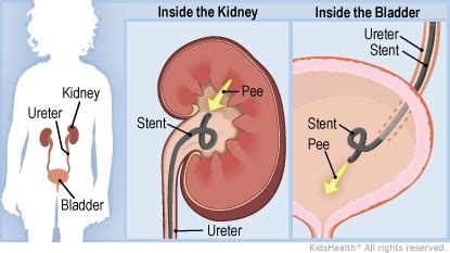 Ureteral Stent