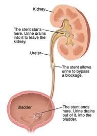 Cystoscopy, Retrograde Pyelogram (RPG) and Insertion of Stent — Gold ...