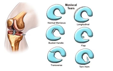 Meniscus Tear in Knee | Signs, Symptoms, Surgery and Rehab | SportsMD