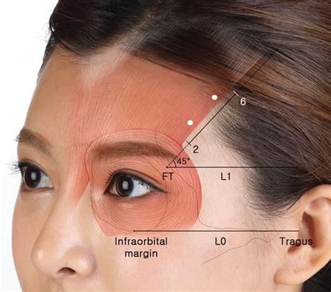 Characterizing the Lateral Border of the Frontalis for Safe and ...