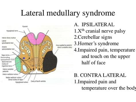 Lateral Pontine Syndrome