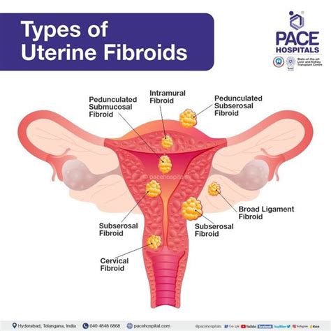 Schematic Drawing Various Types Uterine Fibroids Stock, 50% OFF