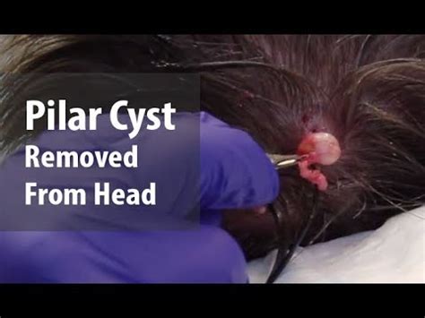 Pilar Cyst Removal | Dr. Derm - YouTube