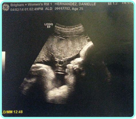 37 weeks- my singleton is alive, in vertex position, and activity is present! - My Little Pea Sprout