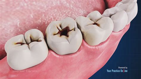 Dental Caries Images