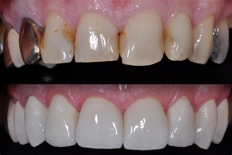 david-before-and-after-1 - Strand on the Green Dental