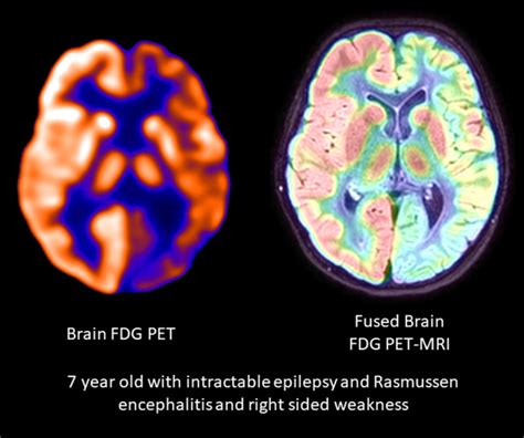 [Figure, Rasmussen Encephalitis Contributed by Djekidel Mehdi MD ...