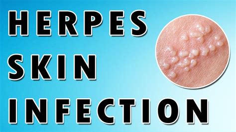 Herpes Simplex Virus Symptoms and Treatment - YouTube