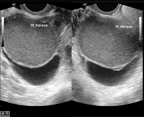 endometrioma ultrasound - Google Search | Endometriosis | Pinterest | Endometriosis and Ultrasound