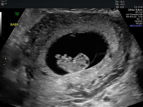 Baby Ultrasound Pictures At 9 Weeks - Baby Viewer