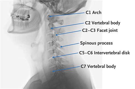 Clinical Examination of the Cervical Spine | NEJM