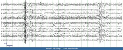 Myoclonic status epilepticus | MedLink Neurology