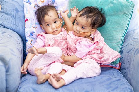 Conjoined twin baby girls separated after major six-hour surgery | News | dailyamerican.com