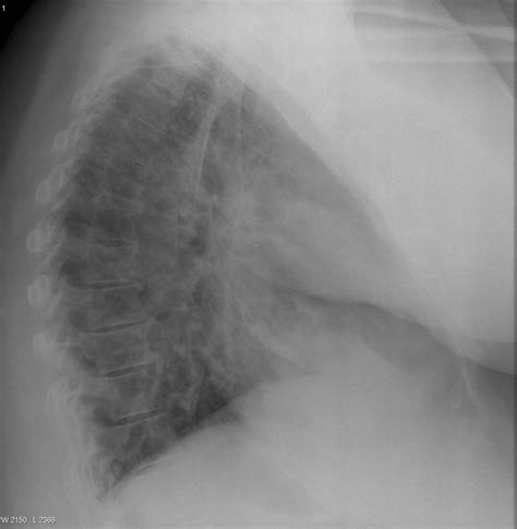 Cystic bronchiectasis | Image | Radiopaedia.org