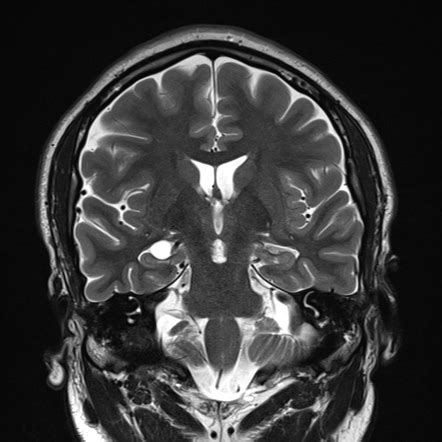 Choroid fissure cyst | Image | Radiopaedia.org