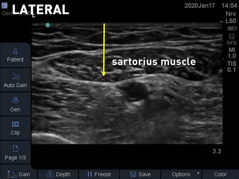 How I Do It: Saphenous Nerve Block