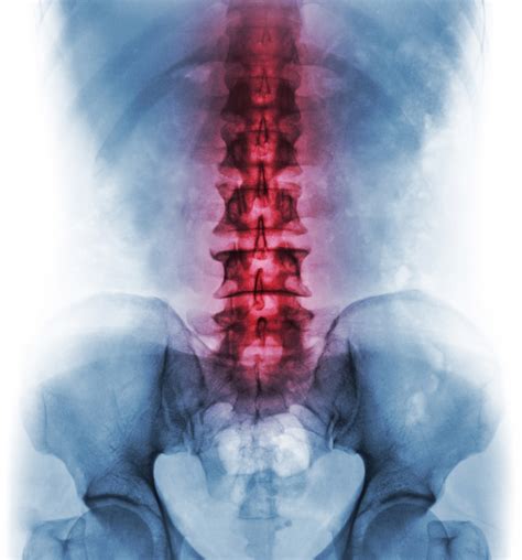 Spinal Adjustment: Can It Help Back Pain?