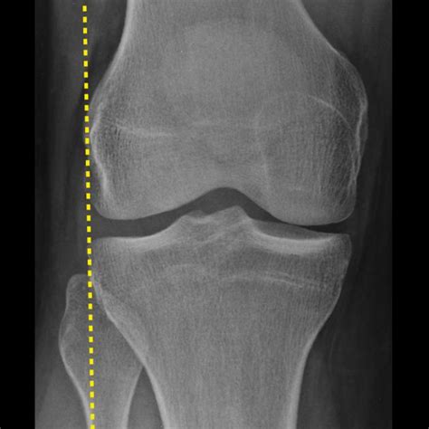 Knee X-rays