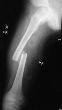 Pediatric Femur Fractures Workup: Plain Radiography, Other Imaging Modalities