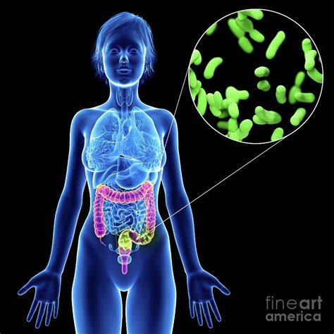 Illustration Of A Woman's Colon Infection Photograph by Sebastian ...