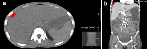 a CT of the abdomen (arrow) showed periportal edema with ascites. b CT... | Download Scientific ...