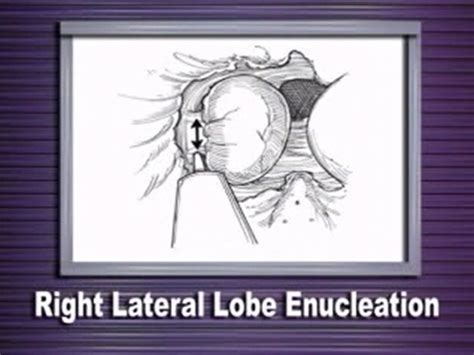 Holmium Laser Enucleation of the Prostate (HoLEP) - Gabani Kidney ...