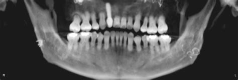 Dentin dysplasia can be seen on this panoramic image. | Download Scientific Diagram