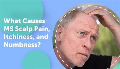 What Causes MS Scalp Pain, Itchiness, and Numbness? | MyMSTeam