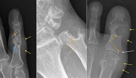 Gouty erosions - Radiology at St. Vincent's University Hospital