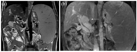 A 36-year-old man with asthenia, abdominal pain, and pruritus. Coronal ...