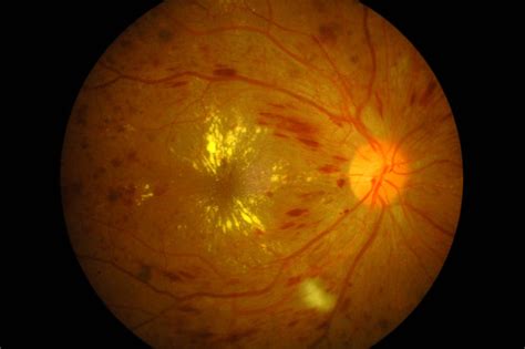 Diabetic retinopathy — Hereford Eye Surgery