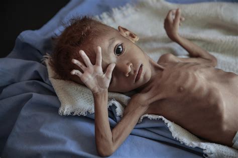 Groups: Both sides used starvation as tool in Yemen war | AP News