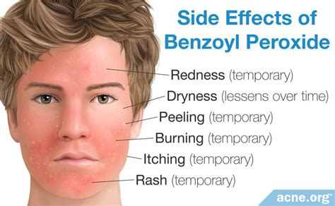 Everything You Need to Know About Benzoyl Peroxide - Acne.org