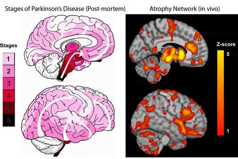 brain mapping parkinson's disease - Neuroscience News