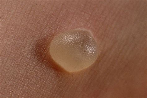 Skin Blisters Causes, Treatment and Prevention | Healthhype.com