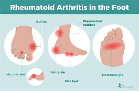 Rheumatoid Arthritis in the Feet: Symptoms and Treatments