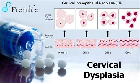 Cervical Dysplasia | Premilife - Homeopathic Remedies